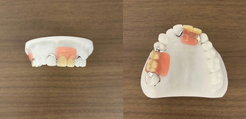 こみね歯科医院 従来の保険の入れ歯