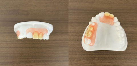 こみね歯科医院 ノンクラスプデンチャー