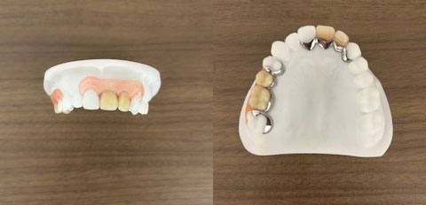 こみね歯科医院 コンティース(デジタル入れ歯)